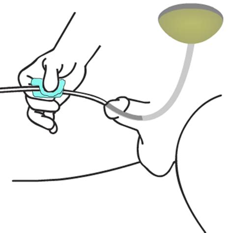 Free catheter sex pics