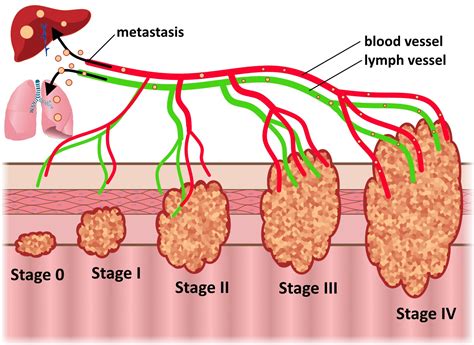 Colorectal Cancer Stages