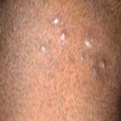 tiny bumps health nigeria