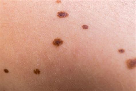 liver spots facty health
