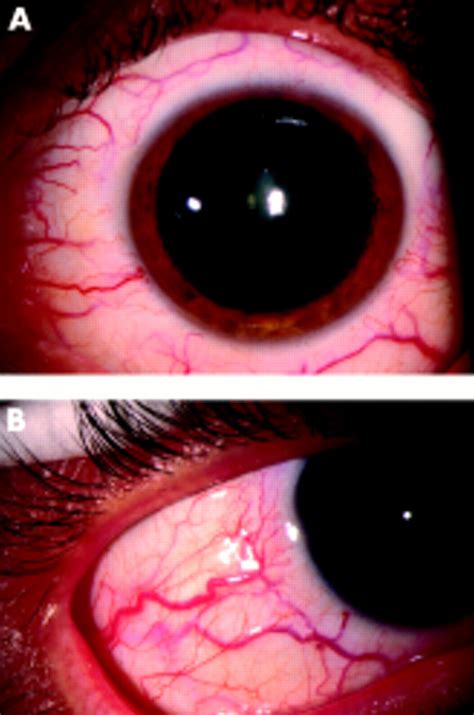idiopathic dilated episcleral veins  increased intraocular pressure