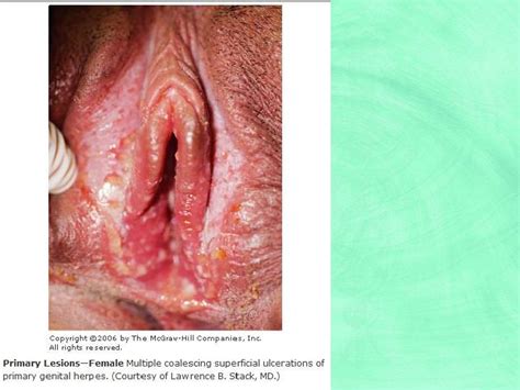 Sexually Transmitted Diseases Pictures