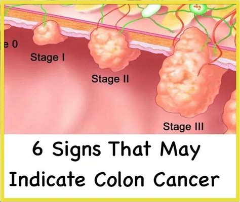 survival rate of stage 4 colon cancer spread to liver