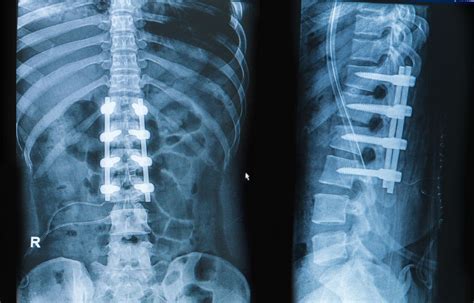 Bone Graft For Spinal Fusion Surgery