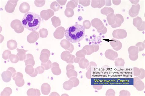 pseudo thrombocytopenia caused  platelet clumps medical laboratories