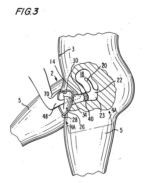 patent us20060231104 female barrier contraceptive with vacuum