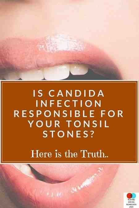 Tonsillitis Candida Associated Stds Throat Sore League