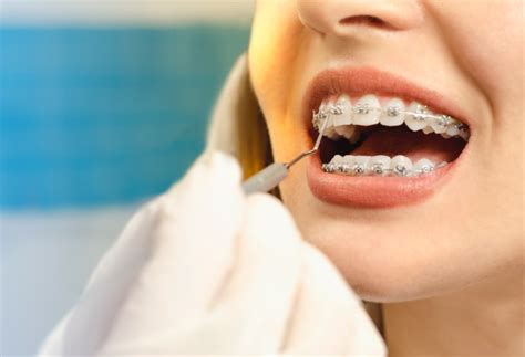 lincoln square dentist offering clearcorrect invisalign straightening