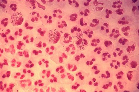 cdc reports a surge in gonorrhea other sexually transmitted diseases