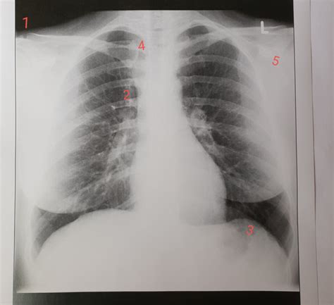 roentgen thorax interpretieren gesundheit und medizin medizin knochen