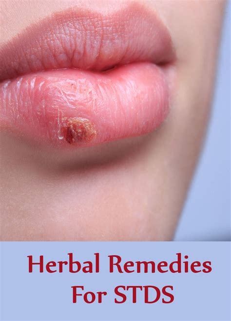 top 5 herbal remedies for stds search home remedy