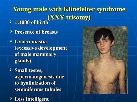 Klinefelter Syndrome Celebrities With Turner Syndrome 🍓klinefelter