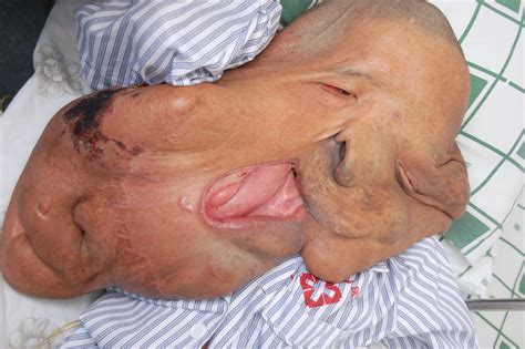 China S Elephant Man Huang Chuncai Undergoes Fourth Surgery To Remove
