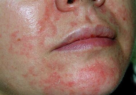 Seborrhoeic Eczema