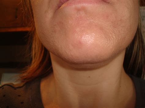 rid   bumps   chin adult acne acneorg