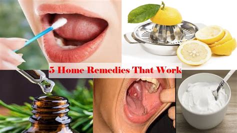 remove tonsil stones  home  home remedies  work
