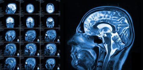 guz mozgu  objawow ktore wymagaja szybkiej wizyty  lekarza