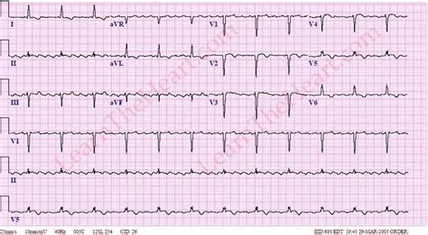 Atrial Flutter With 4 1 Conduction Ecg 2