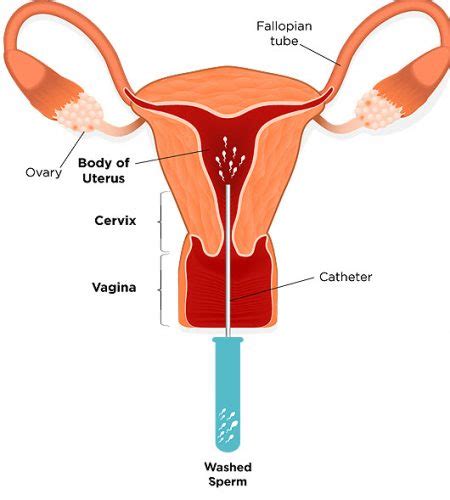 intrauterine insemination best infertility doctors in trivandrum