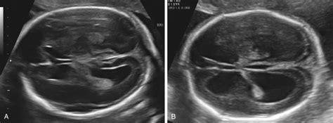 Ultrasound Evaluation Of The Fetal Central Nervous System Radiology Key