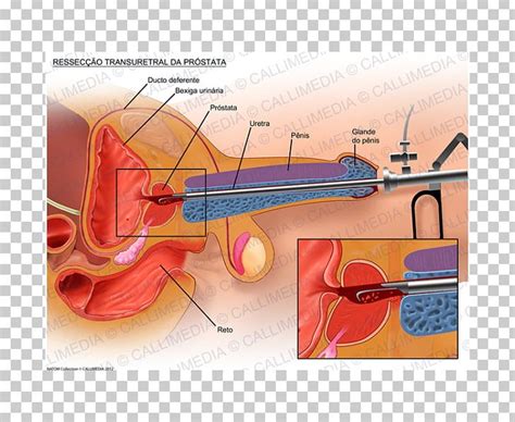 Transurethral Resection Of The Prostate Transurethral