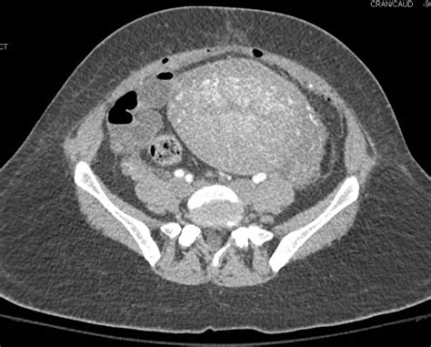 normal uterus ct scan