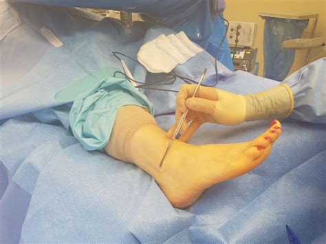 surgical repair  peroneal tendon tear foot  ankle associates