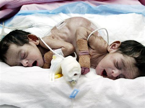 conjoined twins warning graphic images cbs news