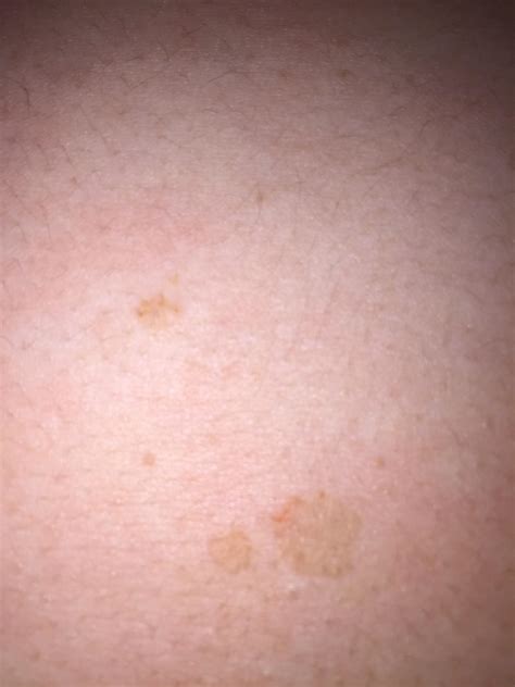 skin concerns strange permanent  spots  appeared