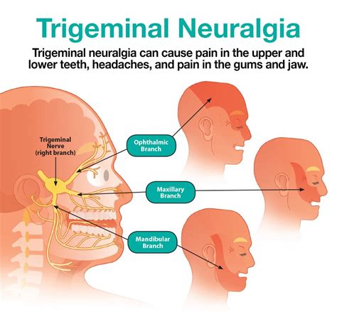trigeminal neuralgia treatment  chennai boston brain  spine care  neurosurgeon