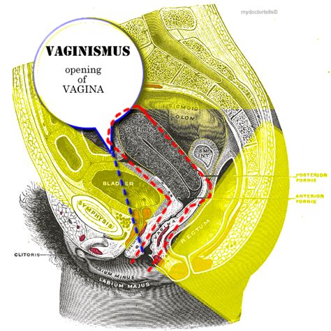 vaginismus my doctor tells