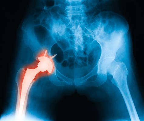 What Surgeons Aren T Saying About Sex After Hip Replacement