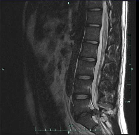My L5 S1 Had A Disc Herniation It Almost Completely Cut