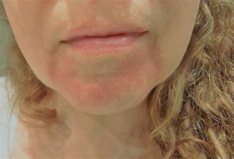 cuidarse  los  dermatitis seborreica