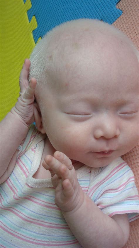 albino newborn baby furosemide
