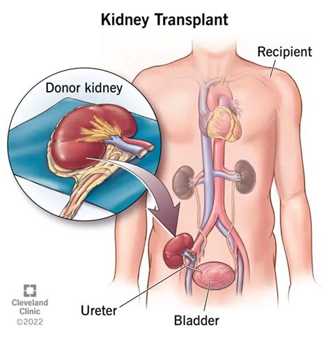 kidney transplant surgery purpose procedure recovery