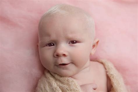 infertile woman  birth  miracle albino baby  world report
