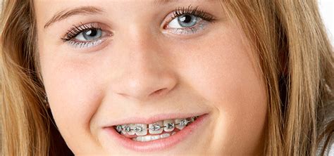 how soon should your pre teen see the orthodontist oakville dental