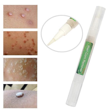 5xgenital wart treatment papillomas removal of wart liquid from skin