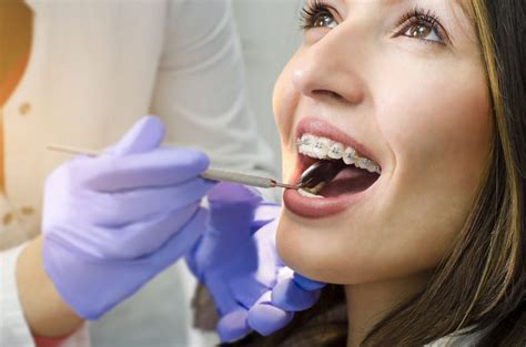 fastbraces dental braces straighten teeth   days