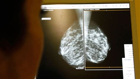 most breast cancer patients who have double mastectomy don t need it