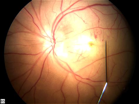 retina retina image bank