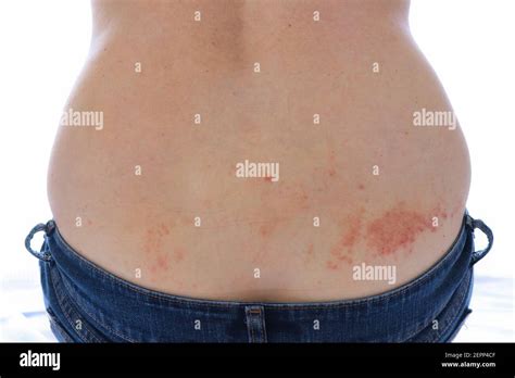 scabies   contagious parasitic skin disease caused  mites burrowing   skin stock