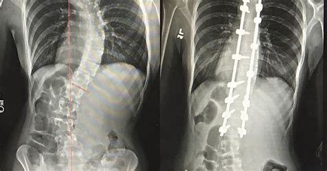 Spinal Fusion Before And After Album On Imgur