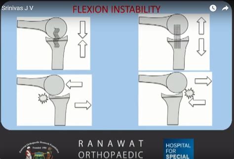 mid flexion instability  total knee replacement