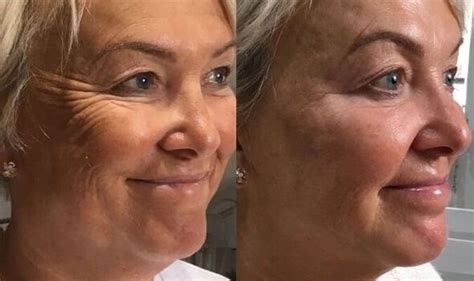 real life 63 year old woman credits youthful appearance to tweakments