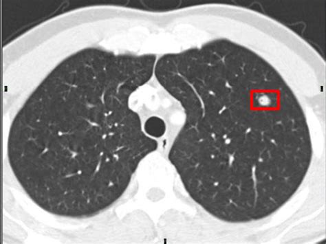 lung nodule malignancy prediction based  sequential ct scans intel