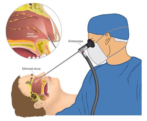 endoscopic sinus surgery long island ny dr michael  cohen