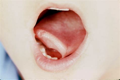 surgery tongue tie