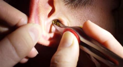 Swolen ear canal